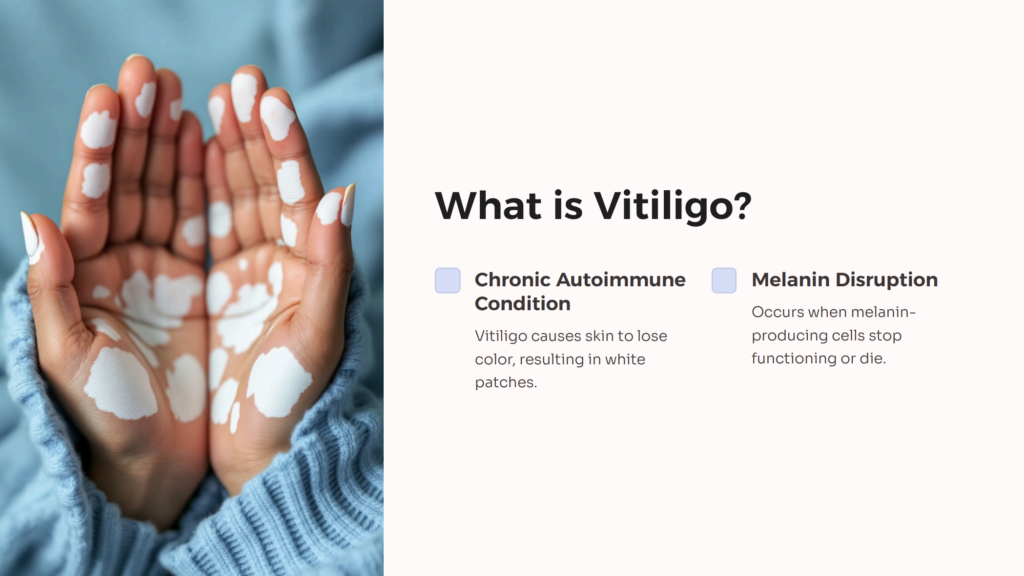 Vitiligo infographic