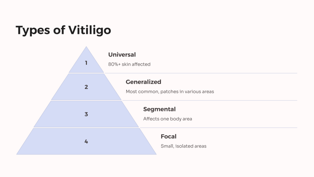 Vitiligo Types infographic