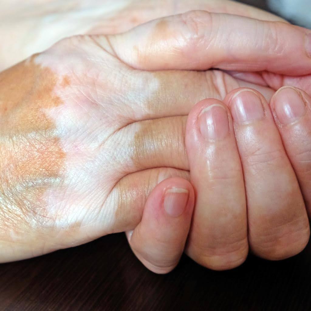 vitiligo-hands